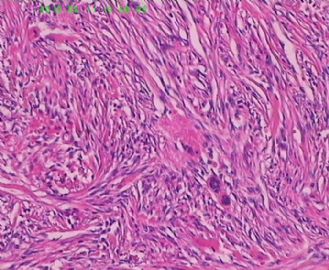 此列该如何诊断呢，皮肤纤维组织细胞瘤？图12