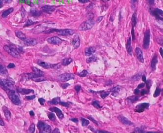 此列该如何诊断呢，皮肤纤维组织细胞瘤？图13