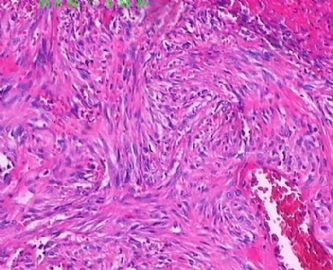 此列该如何诊断呢，皮肤纤维组织细胞瘤？图14