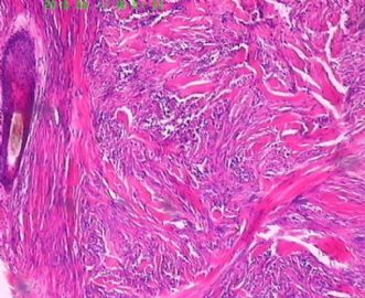 此列该如何诊断呢，皮肤纤维组织细胞瘤？图15