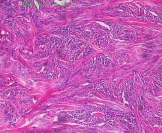 此列该如何诊断呢，皮肤纤维组织细胞瘤？图16