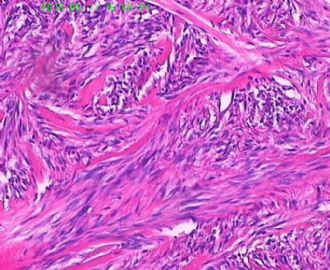 此列该如何诊断呢，皮肤纤维组织细胞瘤？图17