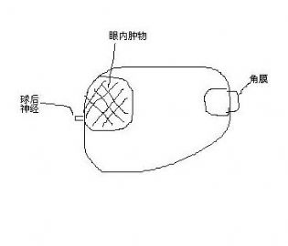 眼内不明肿物图1