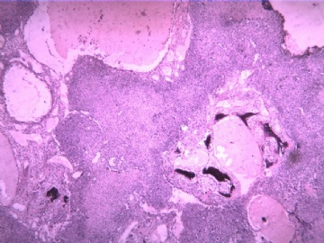 软骨母细胞瘤？（20102009）图9