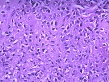 软骨母细胞瘤？（20102009）图17