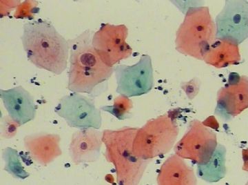 宫颈TCT(10)图3
