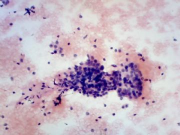 安徽省细胞学诊断及新进展研讨班细胞学读片资料2图3