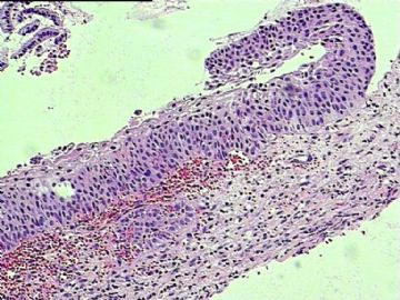 宫颈鳞状上皮，上皮内病变？图3