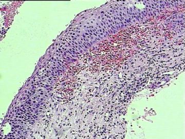 宫颈鳞状上皮,上皮内病变 华夏病理网论坛