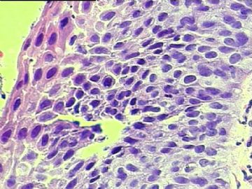 宫颈鳞状上皮，上皮内病变？图10