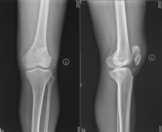 左股骨下段境界清楚的溶骨性破坏（20102491）图1