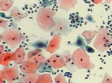 宫颈TCT(12)图7