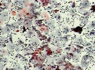 宫颈TCT(13)图1