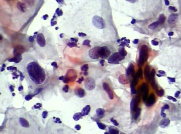 宫颈TCT(13)图4
