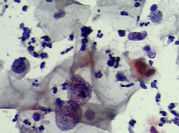 宫颈TCT(13)图6