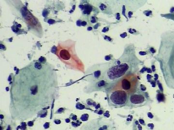 宫颈TCT(13)图12