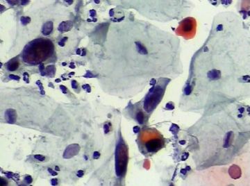 宫颈TCT(13)图13