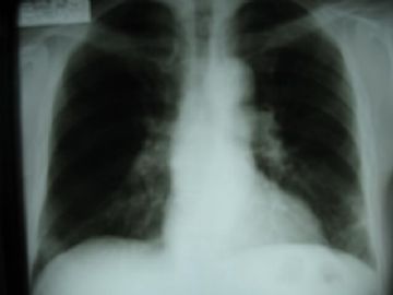 左肺肿块空心粗针活检(肺部恶黑，极其罕见)图1