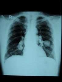 左肺肿块空心粗针活检(肺部恶黑，极其罕见)图2