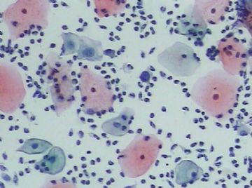 宫颈TCT(14)图4