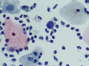 宫颈TCT(14)图5