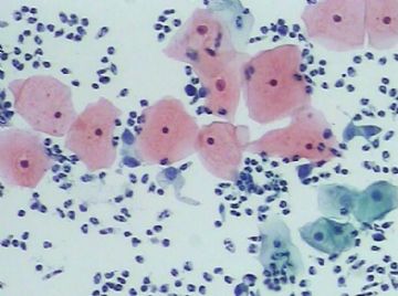 宫颈TCT(14)图6