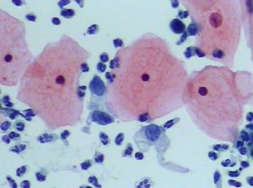 宫颈TCT(14)图7