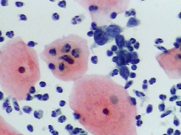 宫颈TCT(14)图8