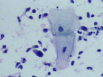 宫颈TCT(15)图5