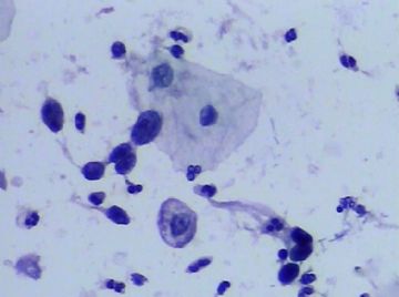 宫颈TCT(15)图7