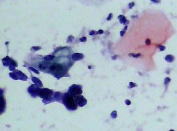 宫颈TCT(15)图9