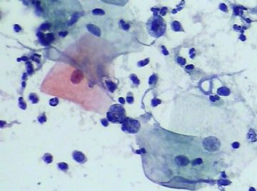 宫颈TCT(15)图13