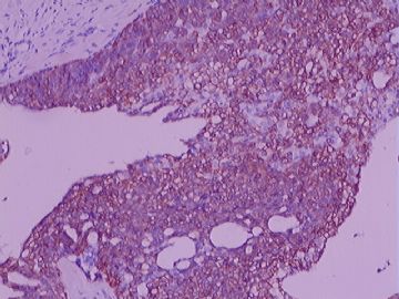 关于不典型或者癌变的免疫标记的困惑，请指教（附病例）图6