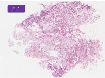 右膝区腓骨头侧皮下肿物图1