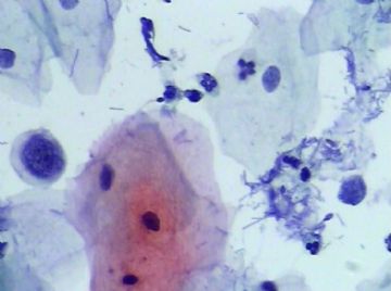 宫颈TCT(16)图2