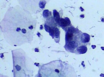 宫颈TCT(16)图6