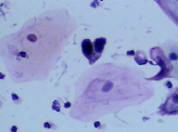 宫颈TCT(16)图8
