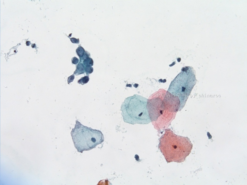 宫颈液基细胞学-地坛7图1