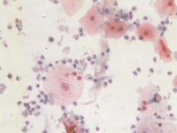 痰细胞涂片图2