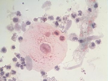 痰细胞涂片图3
