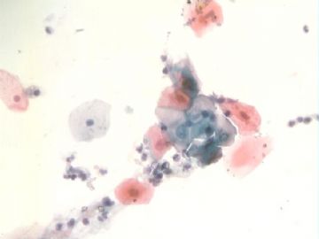 痰细胞涂片图8