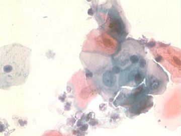 痰细胞涂片图9