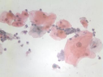 痰细胞涂片图11