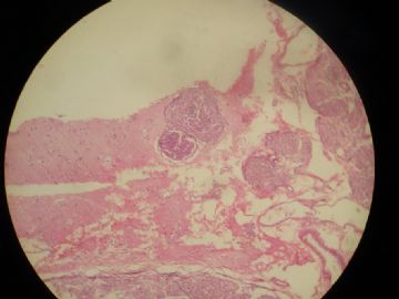 蝶骨嵴脑膜瘤图19