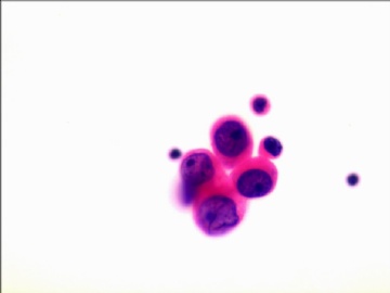 胸水液基制片（HE染色）图6