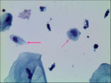 宫颈液基，30岁（组织细胞？）图1