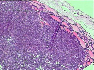 胚胎型滤泡性甲状腺腺瘤？图12