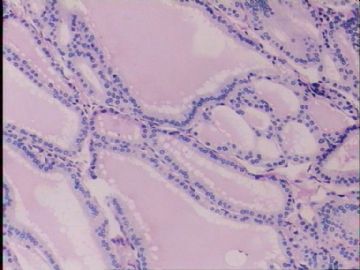 甲状腺肿物图10