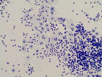 35岁妇女液基细胞学图2