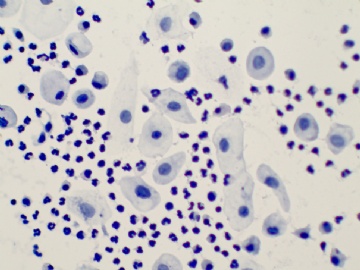 35岁妇女液基细胞学图11